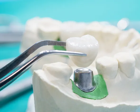 日本口腔インプラント学会専修医による治療