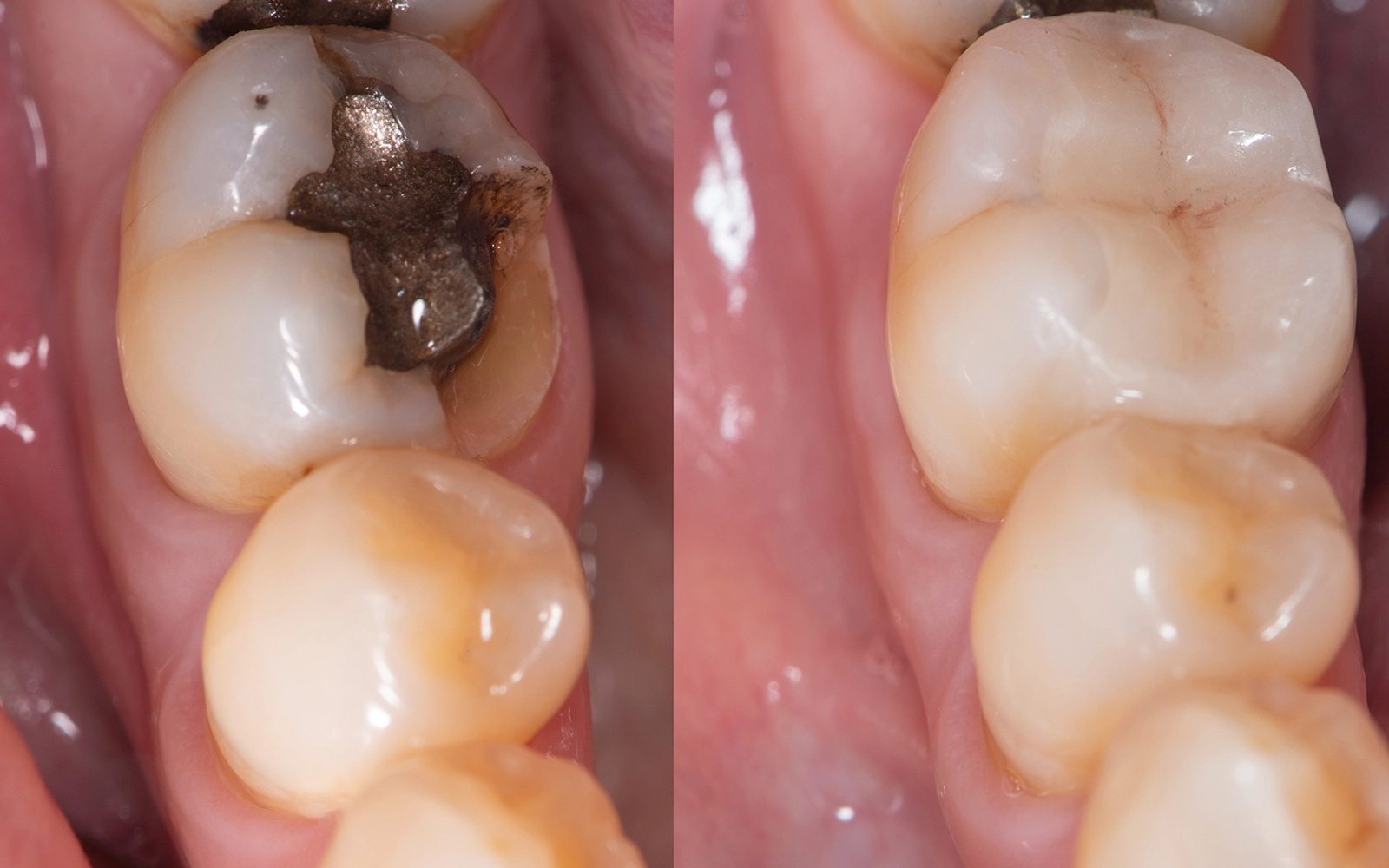 セラミックインレー