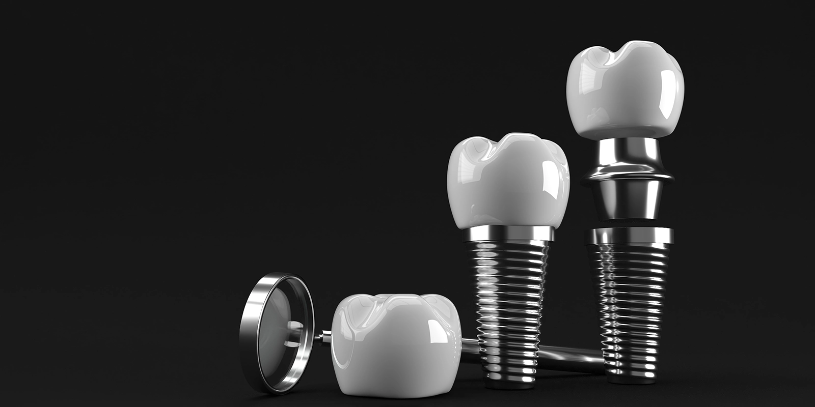 インプラントの3つの構造