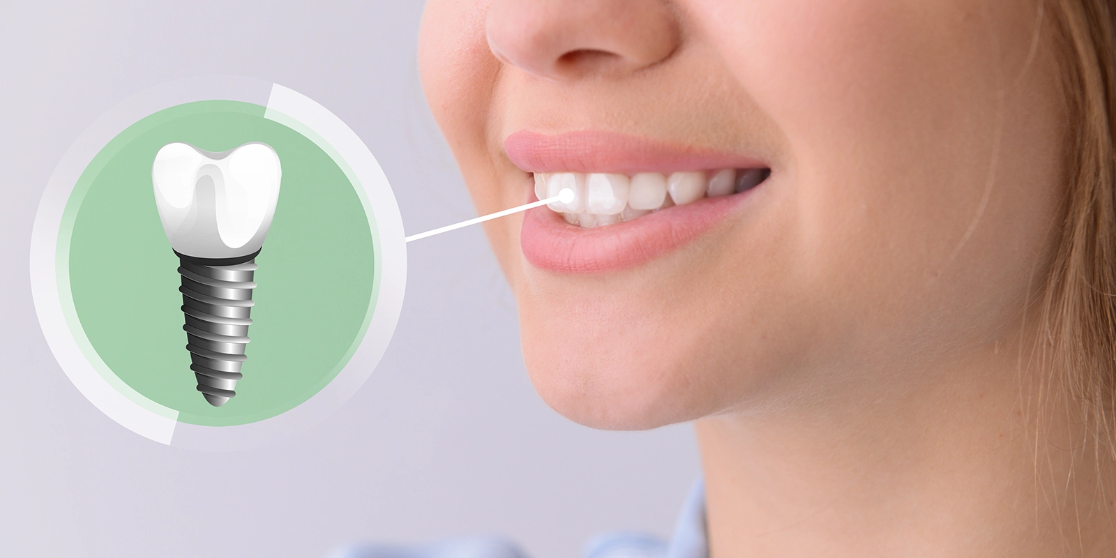 インプラントと入れ歯・ブリッジの比較