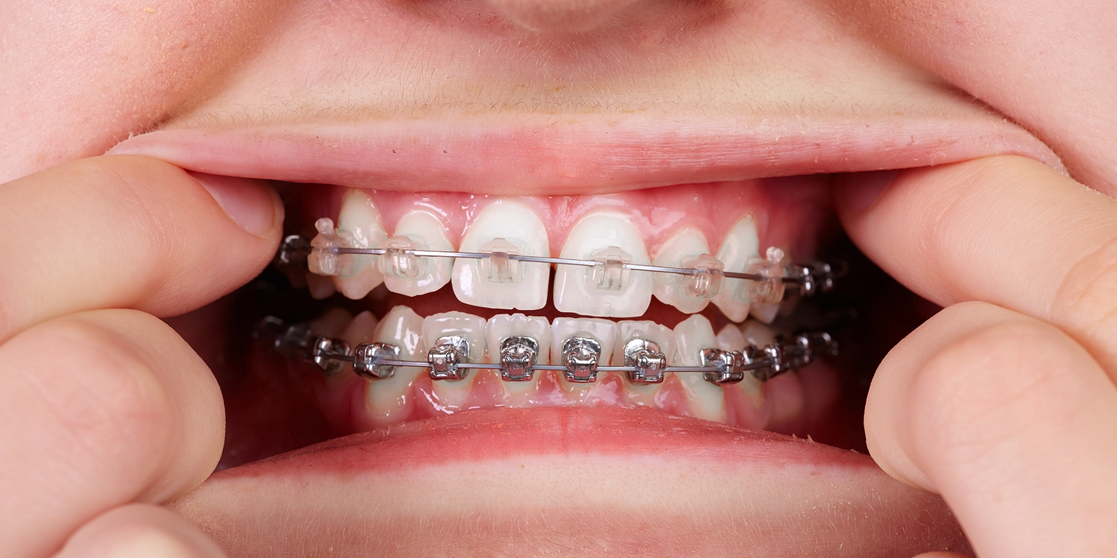 成長を活かした永久歯がきれいに並ぶ土台作り