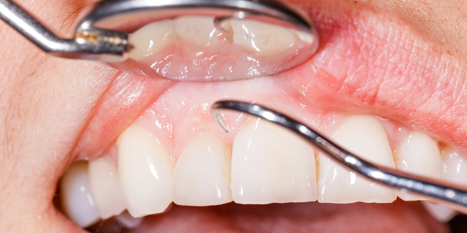 歯周病の治療方法