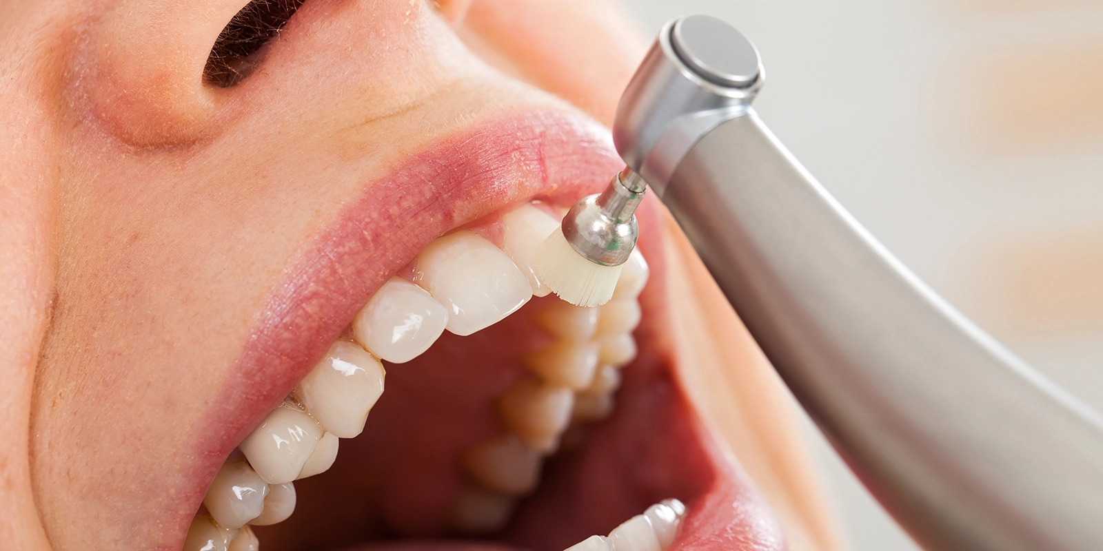 歯科医院で行う予防ケア（プロフェッショナルケア）