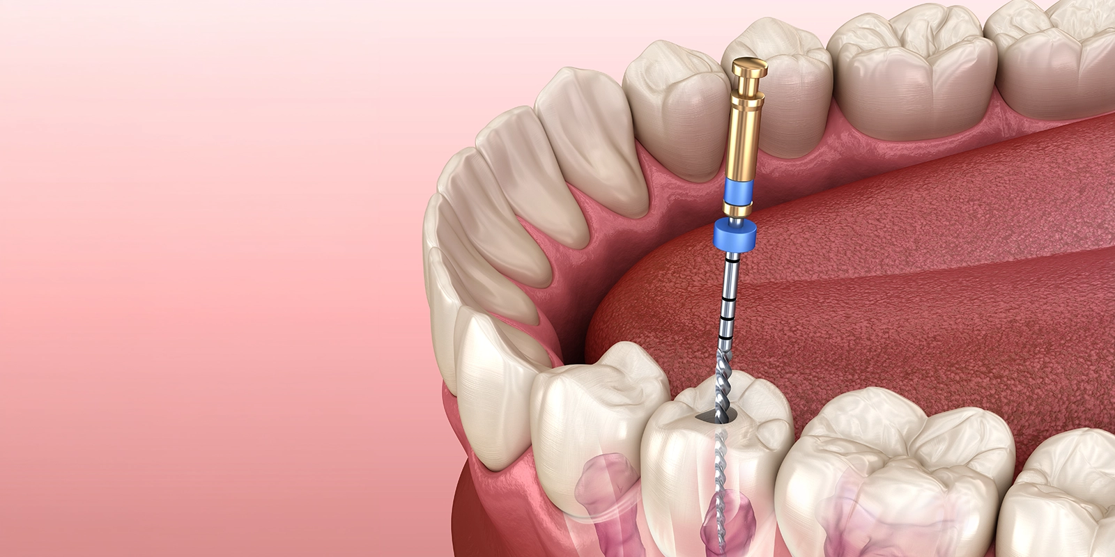 先進機器を用いた精密な根管治療で歯を残す