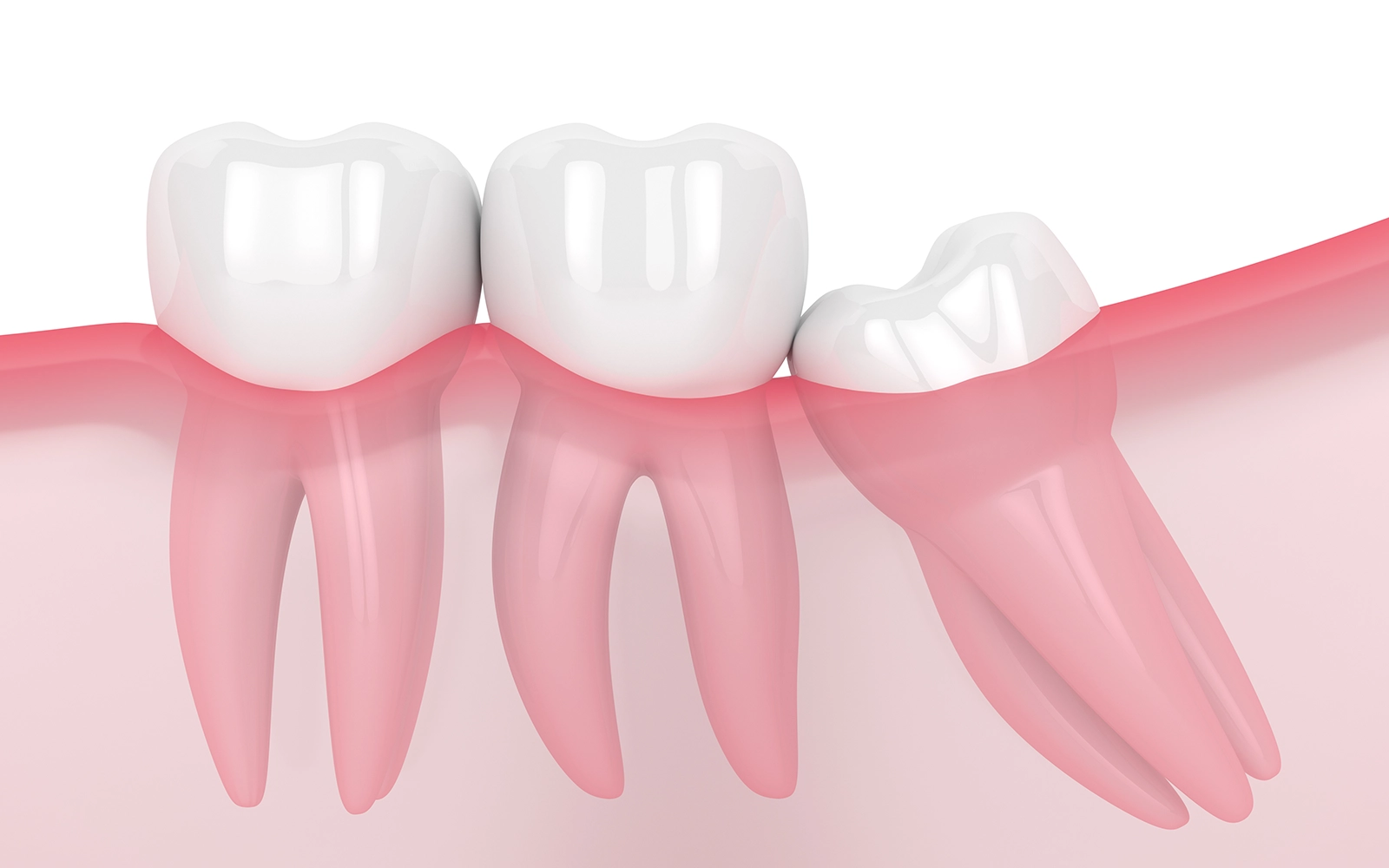 一部だけ歯茎から出ている