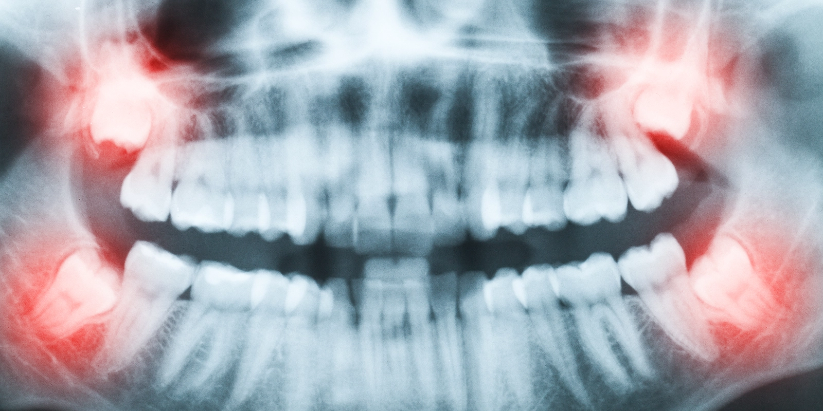 経験豊富な歯科医師による安心の抜歯