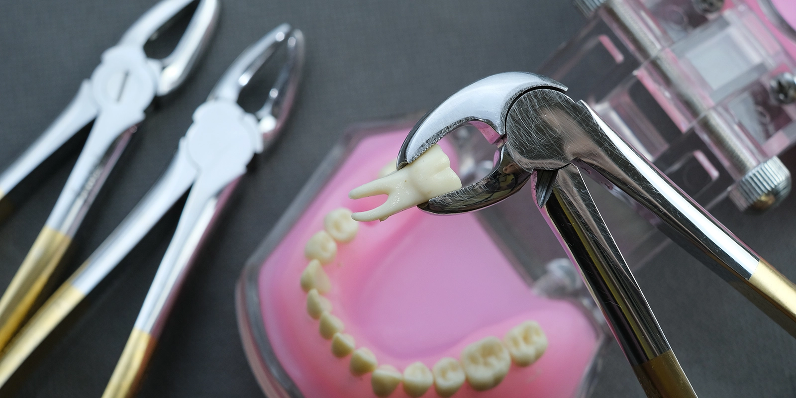 親知らず抜歯の流れと術後の注意点